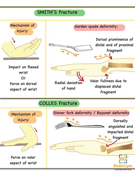 Smith Fracture (Distal Radius Fracture): Definition & Treatment.